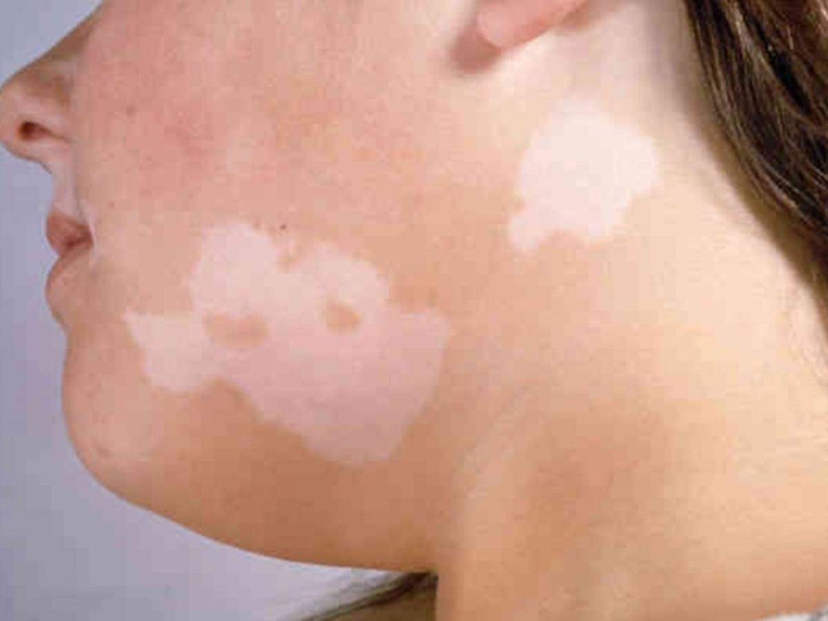 Vitiligo White Spot Leucoderma Surgery 2493