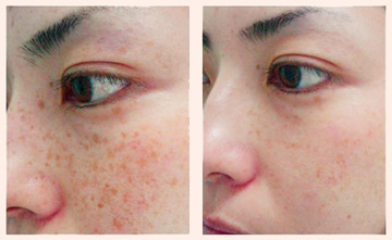 laser freckle removal 500x500 1