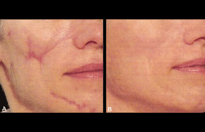 laser treatment scars before after