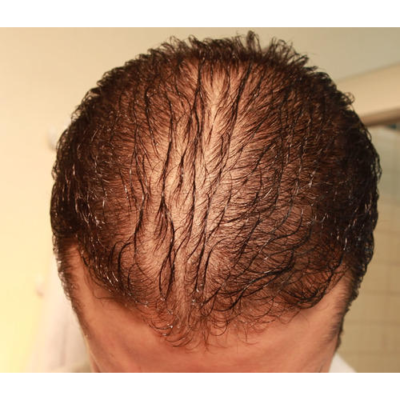 stem cell therapy for hair regrowth service 500x500 1