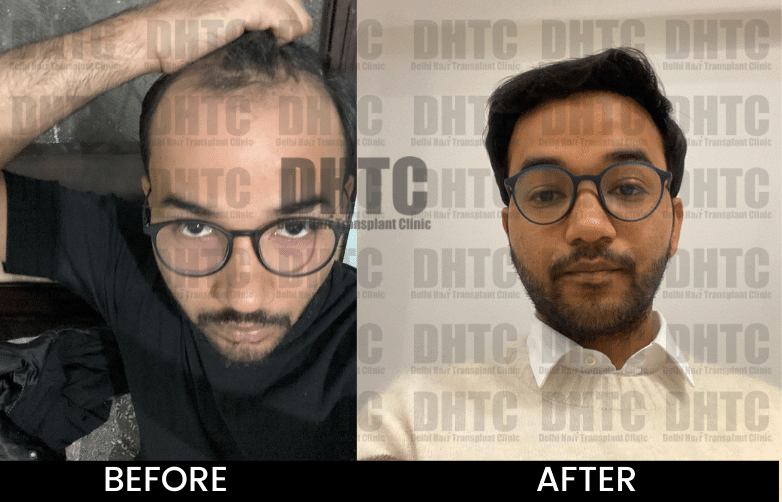 HT Before After 30 min