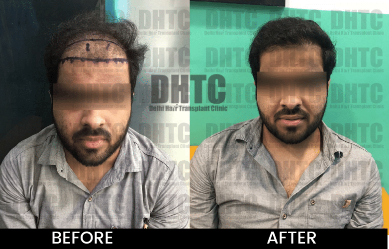 HT Before After (34)-min